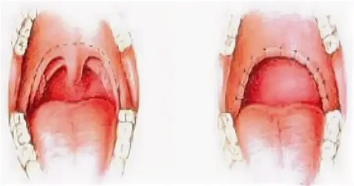 Увулит фото как выглядит внутри What is Chronic Tonsillitis (with pictures)