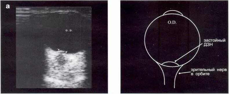 Друзы диска зрительного нерва на УЗИ. Зрительный нерв норма УЗИ. Отек диска зрительного нерва УЗИ. Толщина зрительного нерва на УЗИ. Периневральное пространство зрительного нерва
