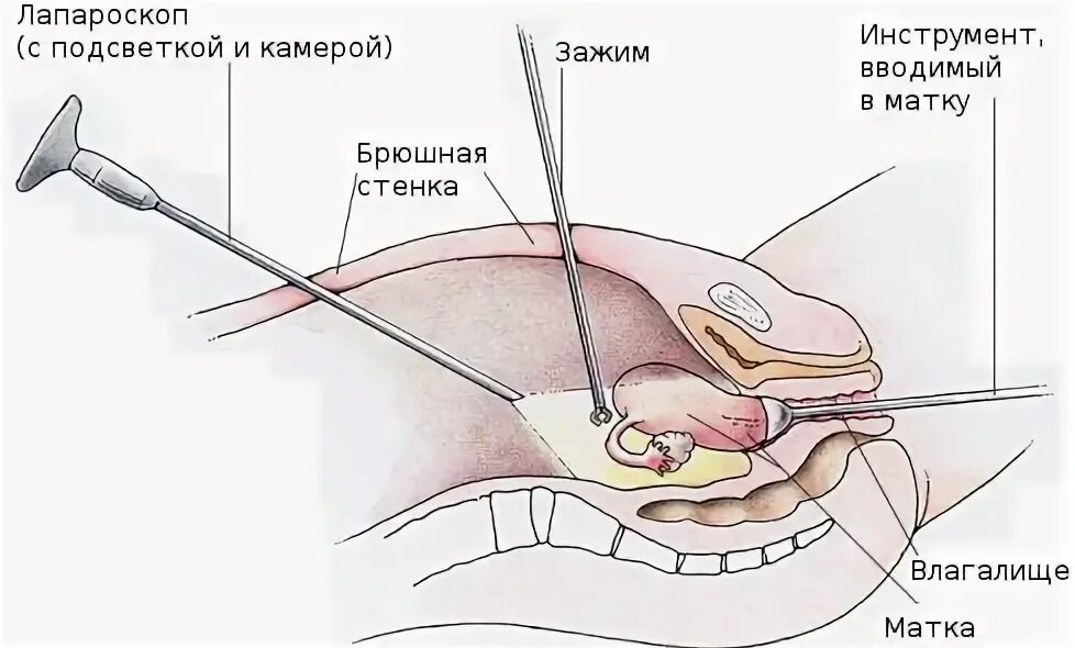Лапароскопия полипа матки. Лапароскопия гинекологические операции. лапароскопия эндометриоидной кисты. лапароскопия резекция яичника. лапароскопия маточных труб.