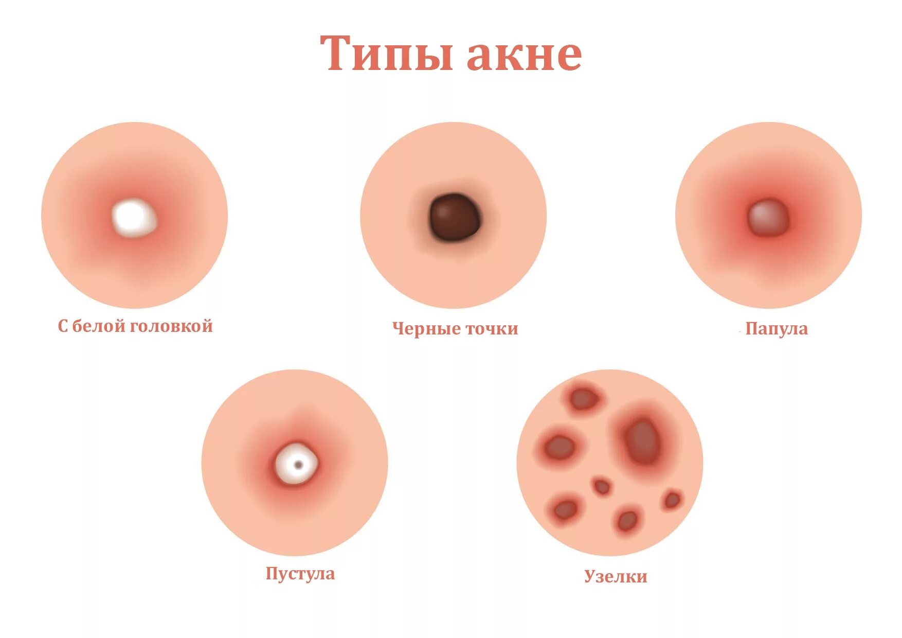 Дырочка в соске. Папула пустула фурункул.