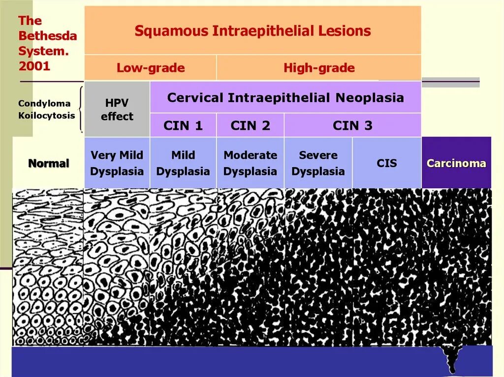 The bethesda system. Bethesda System. Low-Grade squamous intraepithelial lesions. Low Grade squamous intraepithelial lesion что значит. Классификация Бетесда шейка матки.