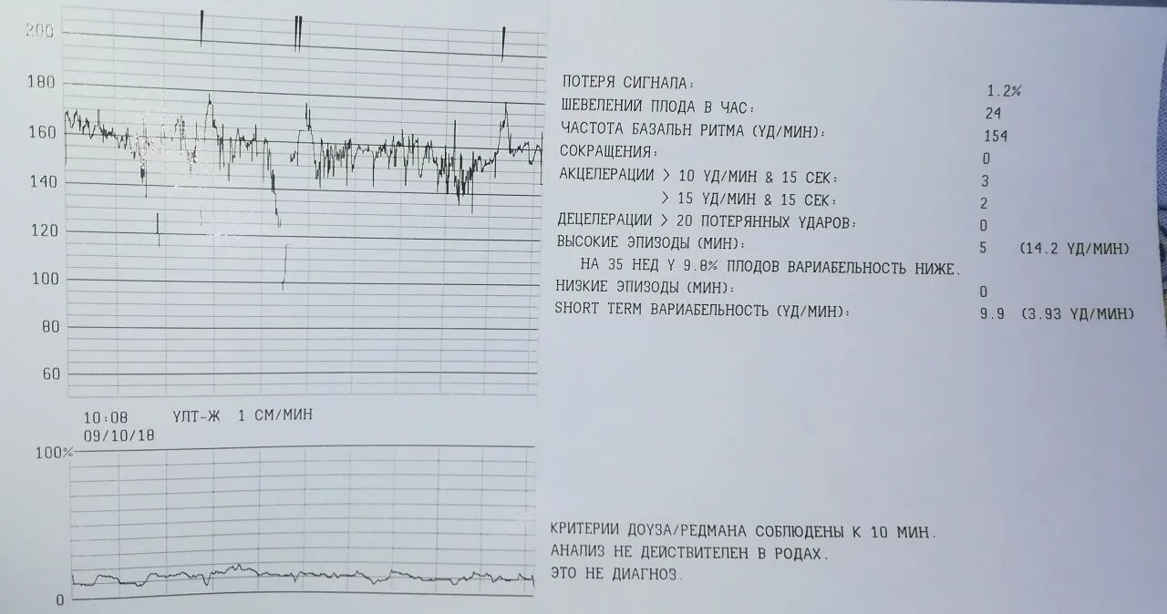 Нормальная диаграмма КТГ. Ундулирующий ритм на КТГ. КТГ при беременности показатели вариабельность. Показатели КТГ норма. 17 недель нет шевелений