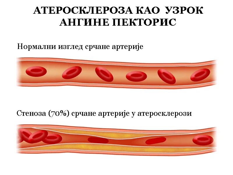 Артерий атеросклероз латынь. Атеросклероз картинки. Абразивный атеросклероз.