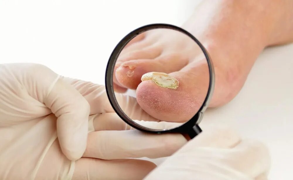 Соберите информацию о грибковых заболеваниях. Грибковые инфекции ногтей.