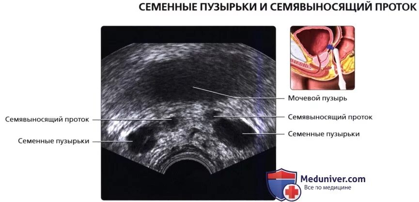 Трансректальное УЗИ предстательной железы. Семенные пузырьки на УЗИ В норме. Норма показателей УЗИ предстательной железы. УЗИ предстательной железы Изранов. Предстательная железа включения