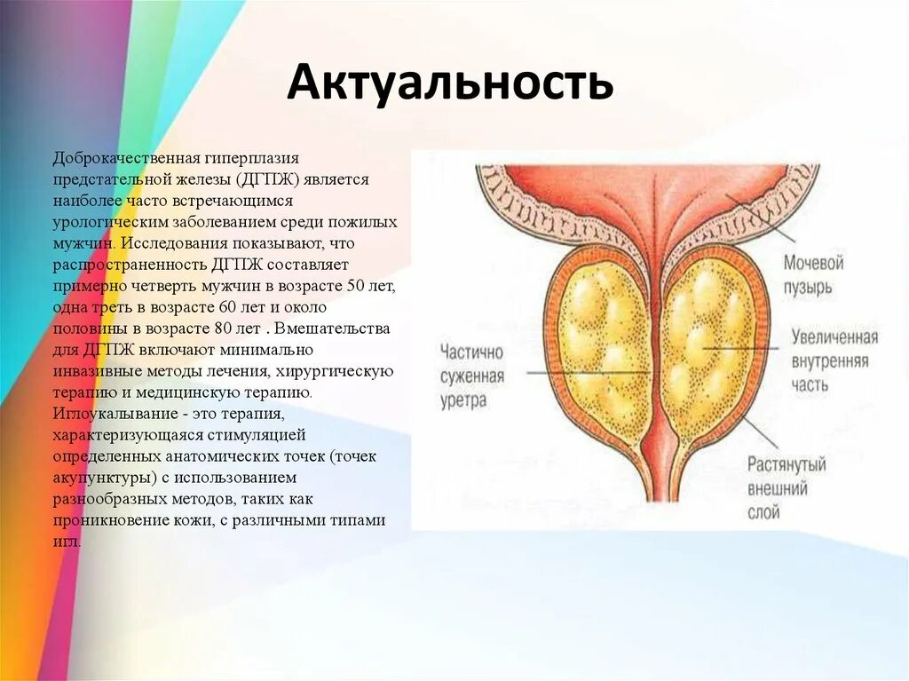 Что значит дгпж. Гиперплазия предстательной железы. Доброкачественная гиперплазия предстательной железы. ДГПЖ предстательной железы что это такое. Доброкачественная гиперплазия предстательной железы (ДГПЖ).