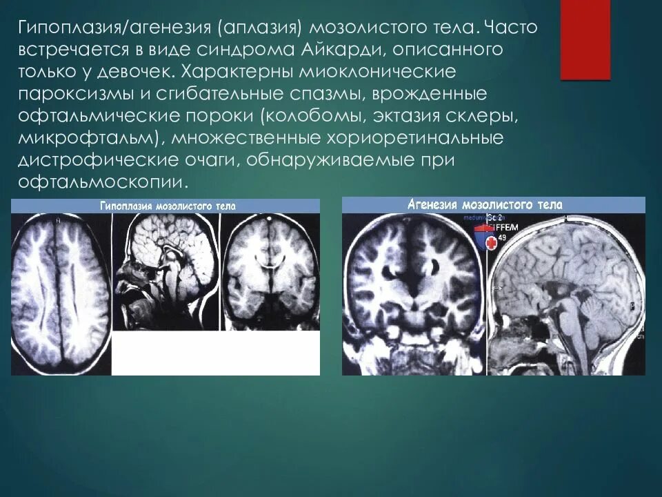 Гипоплазия червя. Агенезия мозолистого тела. Гипоплазия/аплазия мозолистого тела. Аплазия (агенезия) и гипоплазия мозолистого тела.