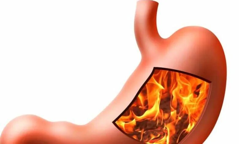 Как называется изжога. Изжога картинки. Основные причины изжоги. Как называется изжога. Симптомы изжоги желудка.