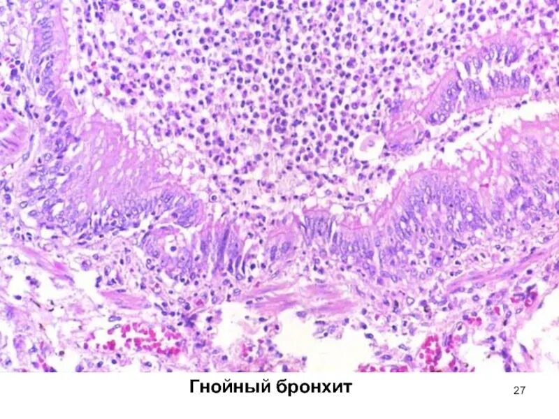 Пневмония бронхиальная сливная. Накопление мокроты в бронхах. Бронхи гной. Бронхи гной. При лечении гнойного бронхита используются.