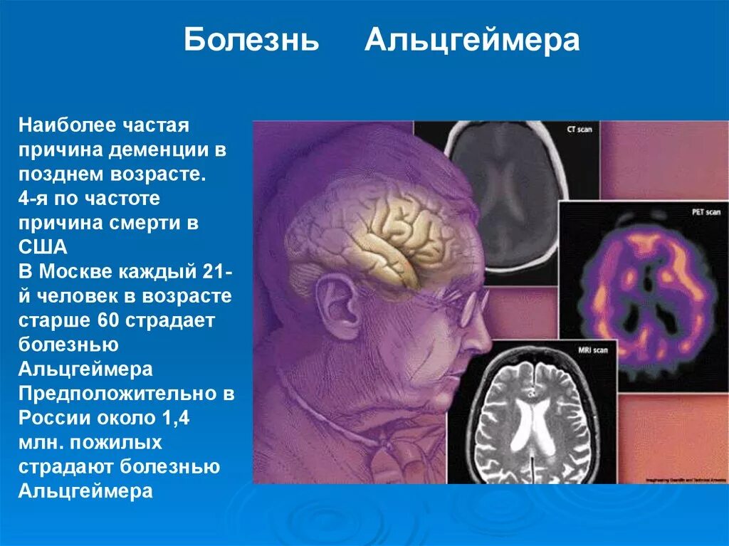 Причины развития альцгеймера. Болезнь альцгеймера. деменция и альцгеймер. болезнь альцгеймера презентация. симптомы деменции альцгеймера.