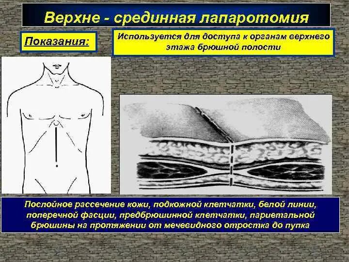 Верхняя срединная лапаротомия. Верхне нижнесрединная лапаротомия. Верхне средне Нижне срединная лапаротомия. Верхняя и нижняя срединная лапаротомия. Нижняя лапаротомия