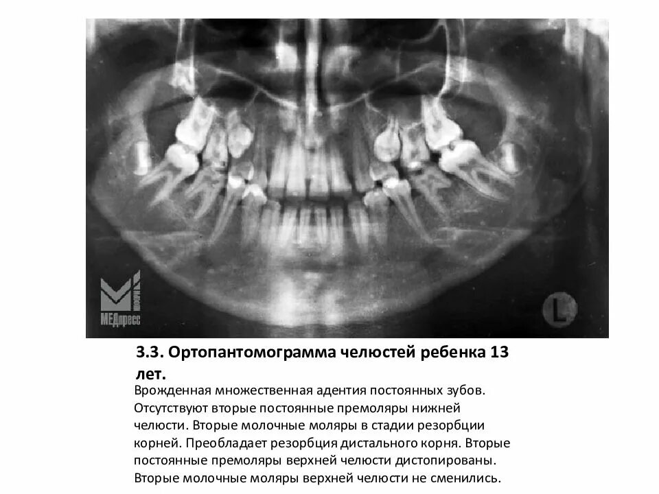 Снимок верхней и нижней челюсти