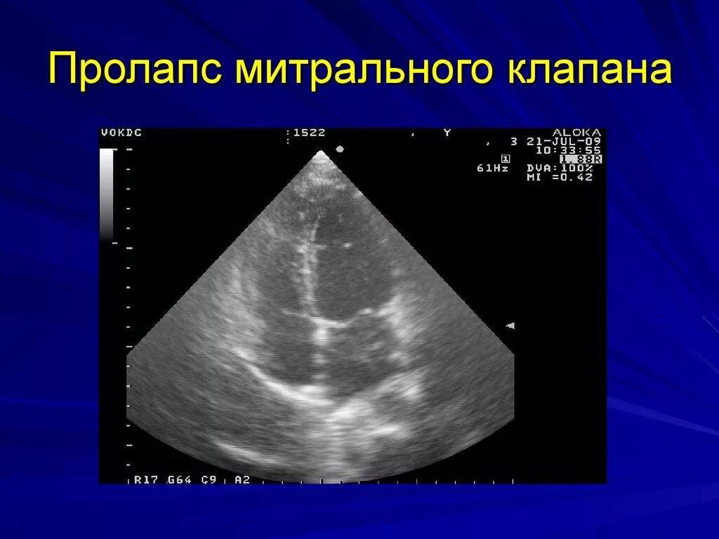 Что такое пролапс митрального клапана. УЗИ сердца пролапс митрального клапана. УЗИ сердца пролапс митрального. Пролапс митр клапана. Пролапс митрального клапапан.