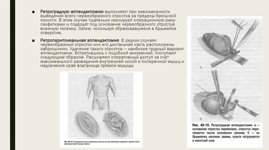 Удаление аппендицита питание. Антеградная и ретроградная аппендэктомия этапы. Антеградная аппендэктомия аппендэктомия. Нейроэндокринная опухоль червеобразного отростка. Этапы ретроградной аппендэктомии операции.