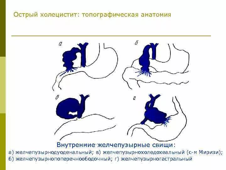 Острый холецистит анатомия. Острый холецистит протокол. Острый ферментативный холецистит. Острый холецистит тесты с ответами