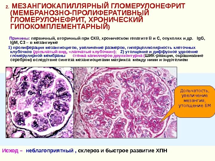 Мембранопролиферативный (мезангиокапиллярный) гломерулонефрит. Мезангиокапиллярный гломерулонефрит морфология. Мезангиокапиллярный гломерулонефрит гистология. Гломерулонефрит почки макропрепарат. Хронический диффузный гломерулонефрит