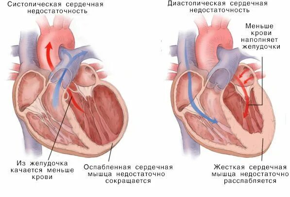 Дисфункции желудочков сердца. Гипертрофия левого желудочка сердца. Левый желудочек сердца. Левый желудочек сердца функции. Причины диастолической дисфункции левого желудочка.