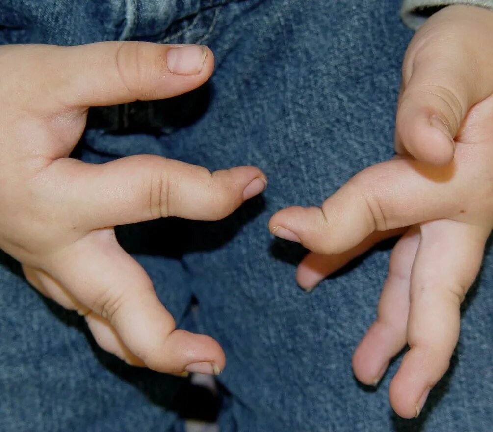6 пальцев на руках у детей. Гиперподвижность суставов дисплазия соединительной ткани. ДСТ дисплазия соединительной ткани. Синдром гипермобильности суставов.