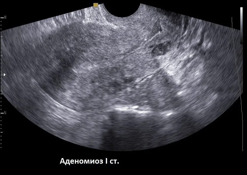 Узловая форма аденомиоза по УЗИ. Узловой аденомиоз матки на УЗИ. Не видна матка на узи