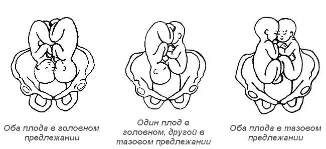 Как рожают двойню естественным путем
