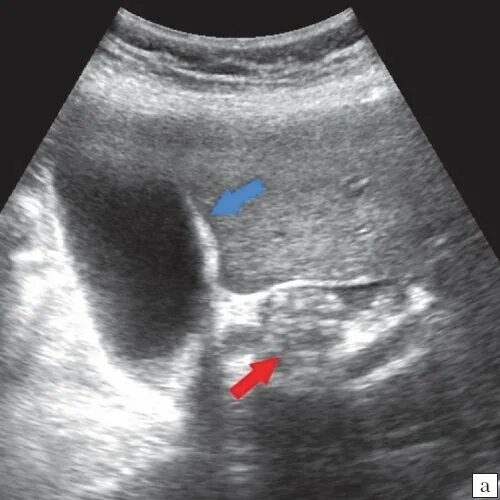 Гиперэхогенные включения в желчном пузыре. Водянка желчного пузыря на УЗИ. Конкремент в пузырном протоке на УЗИ. УЗИ картина водянки желчного пузыря. Холестероз желчного пузыря.