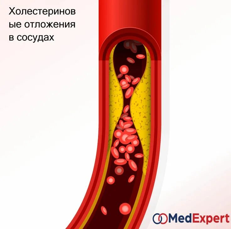 Вино атеросклероз