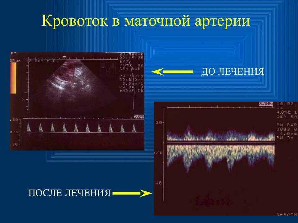 Повышен маточный кровоток. Кроанток в матосных артеричх. кровоток в маточных артериях. нарушение кровотока в маточных артериях. сниженный кровоток маточной артерии.