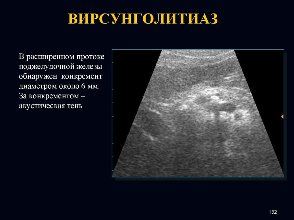 Расширение панкреатического протока. Вирсунголитиаз хронический панкреатит. УЗИ поджелудочной железы презентация. Расширен проток поджелудочной