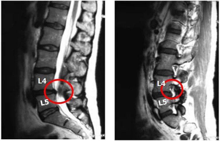 Грыжа 6 мм. Протрузия диска l2-l3. Диски l5-s1 в позвоночнике. Диски позвоночника l4-l5 грыжа. Диски l4 s1 позвоночника.