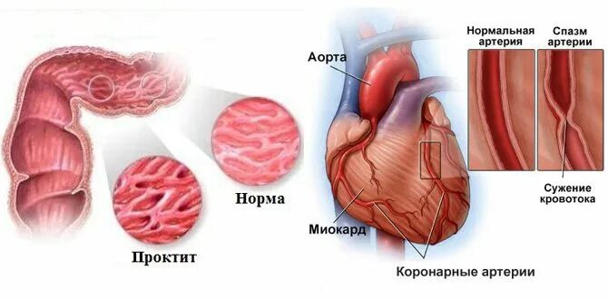 Лечение проктита прямой