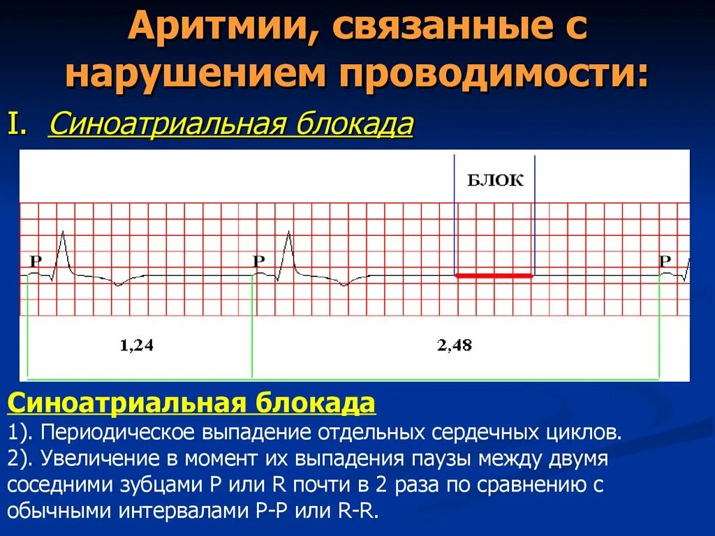 Клинические проявления нарушений ритма и проводимости. Аритмия проводимости. Дромотропные аритмии причины. Аритмия проводимости. Аритмия проводимости.