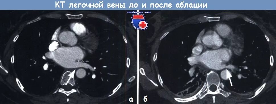 Тромбоз легочных вен кт. Расширение легочных вен. Изоляция легочной вены