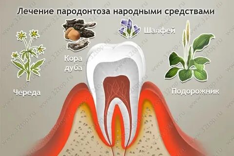 Пародонтоз лечение домашними средствами