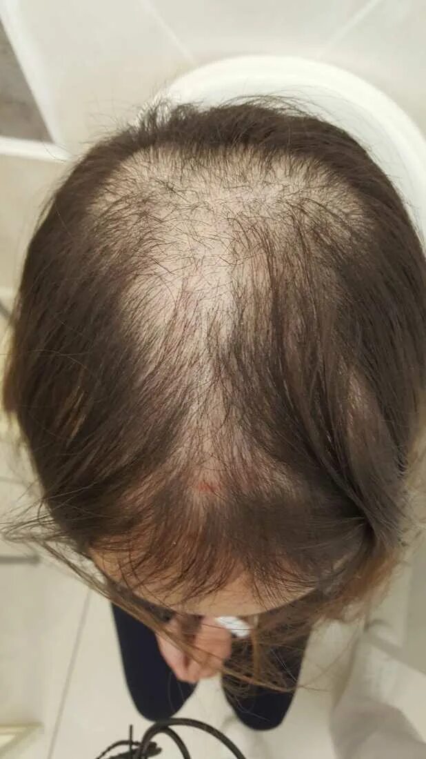 Выдергивание волос болезнь. Выдергивание волос на голове. Заболевания кожи головы. Стрижки с алопецией у женщин. Волосы после выдергивания.