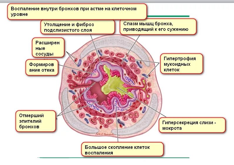 Астма кашель с мокротой. Тип мокроты при бронхиальной астме. Воспаление при бронхиальной астме. Бронхиальная астма мокрота. Бронхиальная астма патофизиология.