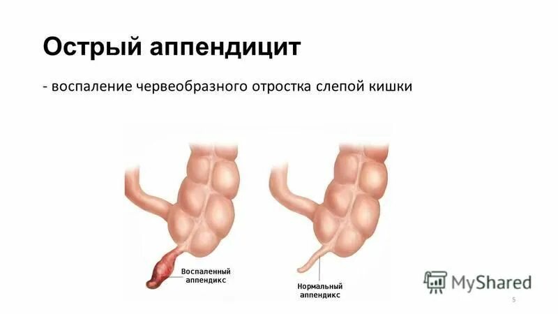 Аппендицит неотложная. Аппендикс воспаление аппендикс отросток. Червеобразный отросток слепой кишки. Воспаленный аппендикс Размеры. Воспаление червеобразного отростка.