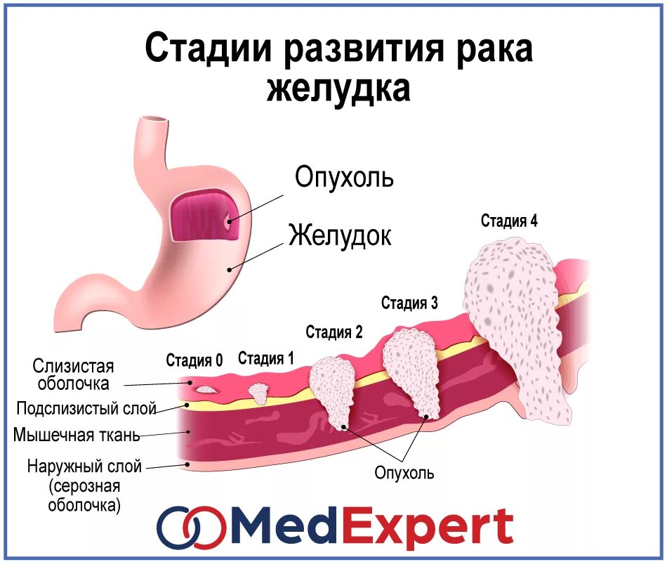 Сколько лечится рак. Опухоль желудка стадии. Стадии карциномы желудка. Раковая опухоль желудка.