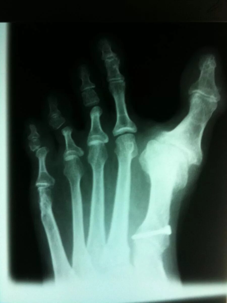перелом основной фаланги 1 пальца стопы рентген. перелом основной фаланги 1 пальца стопы рентген. внутрисуставной перелом фаланги пальца рентген. перелом фаланги пальца на ноге. перелом мизинца рентген.