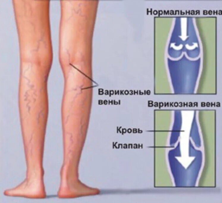 Суть варикоза