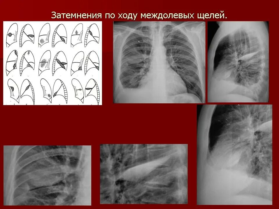 Рентген огк анатомия. Слева по ходу. Определить болевые точки почки у детей. Невралгия грудной клетки. Седалищный нерв боль в крестце.