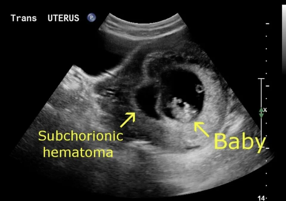 Отслойка хориона на ранних сроках. Субхориальная гематома УЗИ. Ретрохориальная гематома на УЗИ. Гематома на УЗИ при беременности на ранних сроках.