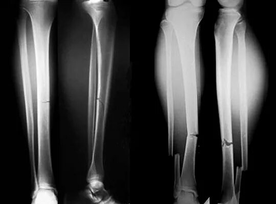 Перелом берцовой кости рентген. Берцовая кость перелом. Перелом голени большеберцовой кости. Перелом большеберцовой кости рентген. Перелом малой берцовой кости со смещением.