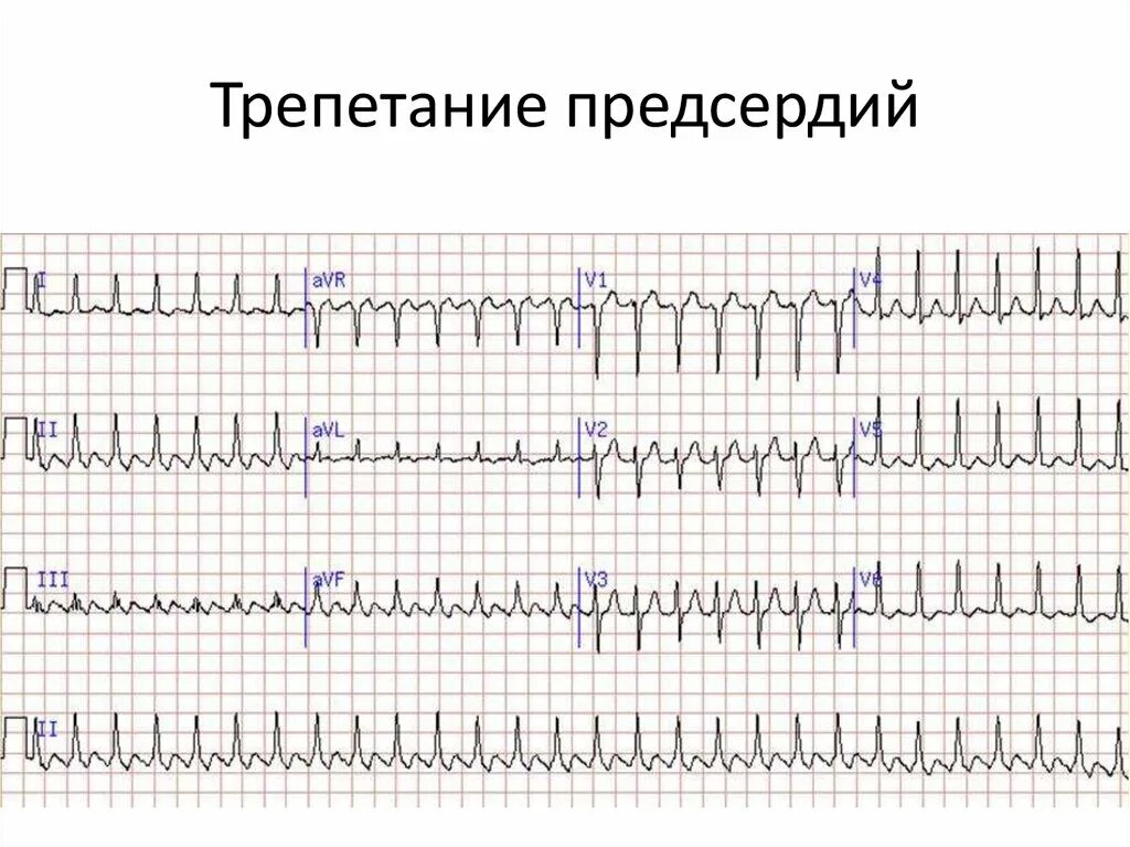 Тахисистолия это. Фибрилляция предсердий ЭКГ тахисистолия. Типичное трепетание предсердий ЭКГ. Правильная форма трепетания предсердий на ЭКГ. Атипичное трепетание предсердий на ЭКГ.