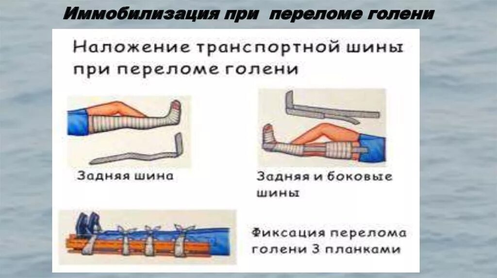 При открытом переломе ответ на тест. Иммобилизация шинами при переломе голени. Транспортная иммобилизация при переломе костей голени. Наложить шину при переломе костей голени. Шина при переломе костей голени.