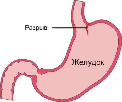 Малори синдром Маллори Вейсса. Синдром Мэллори Вейса картинки. Синдром Маллори-Вейсса это что такое Мэллори Вейса.