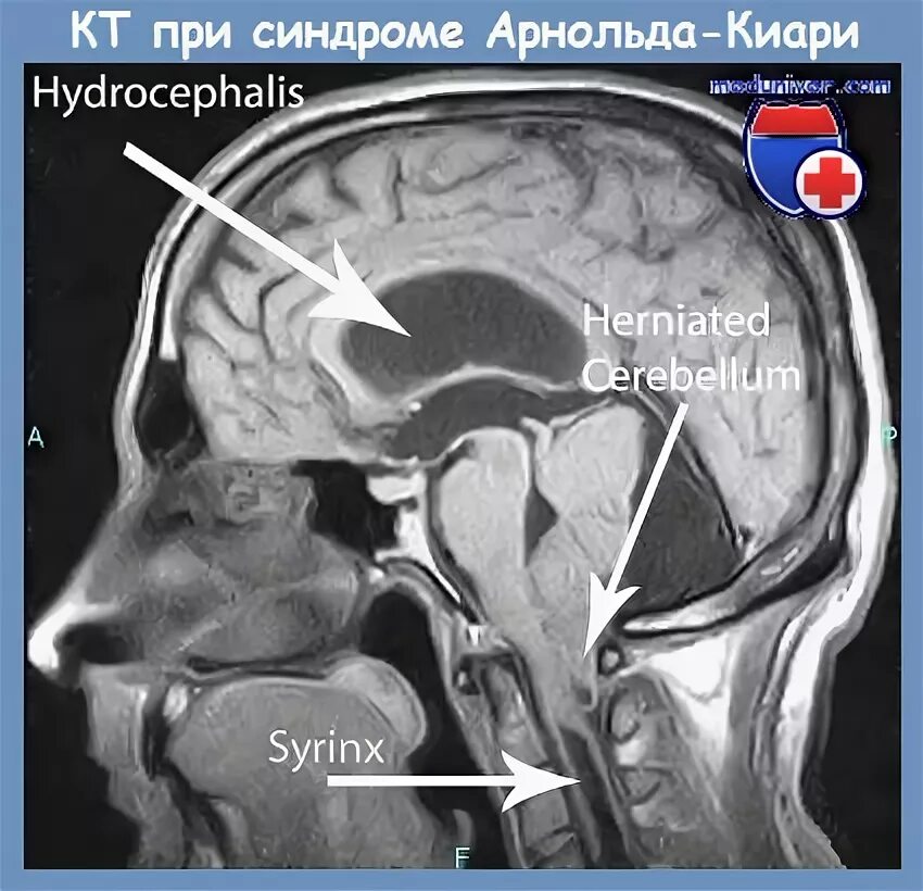 Синдром арнольда. Синдром арнольда-киари и гидроцефалия. арнольда-киари, гидроцефалия. аномалия арнольда киари шунтирование.