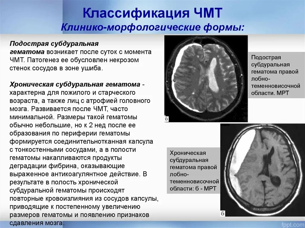 Гематома черепно мозговой травме. Субдуральная и эпидуральная гематома. Подострая субдуральная гематома на кт. Субдуральная гематома НСГ. Хронические субдуральные гематомы на кт.