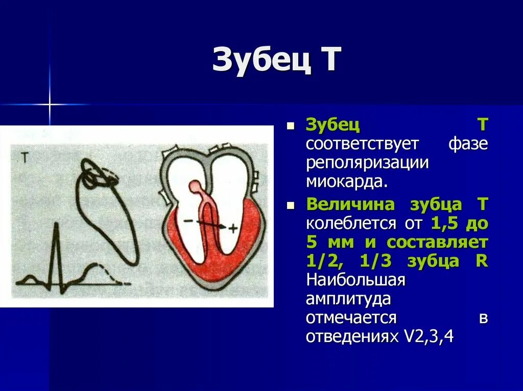 Передний инфаркт миокарда без зубца q. Не q инфаркт миокарда на экг. Патологический зубец q на экг. Инфаркт миокарда без зубца q на экг. Патологический зубец q.