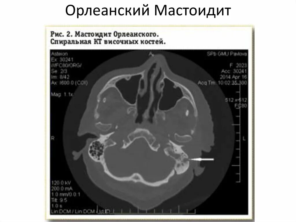 Утолщение слизистой сосцевидного отростка. Хронический мастоидит на кт. Кт височной кости при мастоидите.