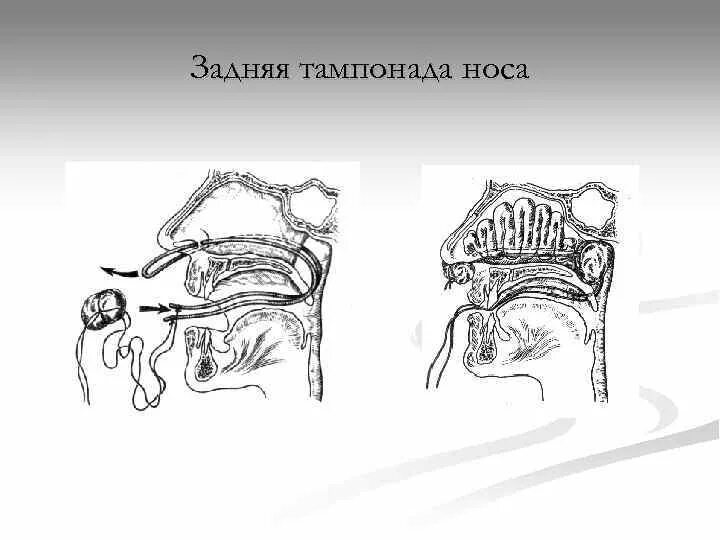 Заднее носовое кровотечение. Тампонада носовых ходов марлевой турундой. Петлевая тампонада носа. Носовые кровотечения задняя тампонада. Задняя тампонада носа алгоритм.